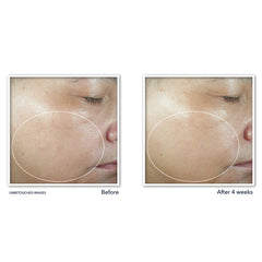 MULTI CORREXION® Even Tone + Lift Resurfacing Serum